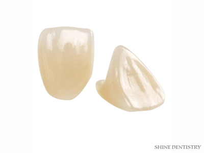 E-Max Crowns in Tiruppur