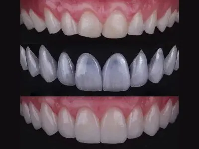 Cosmetic dentistry services at Shine Dentistry Tiruppur