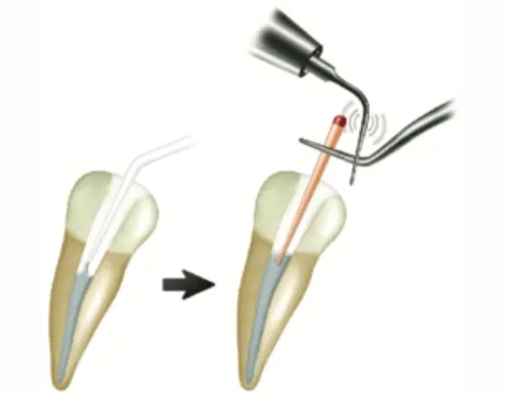 Tooth filling and root canal services by dentist in Tiruppur