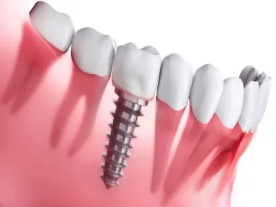 Dental implants at Shine Dentistry dental care Tiruppur