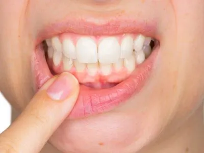 Gum treatments at Shine Dentistry dental care Tiruppur