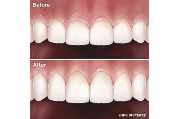 Gummy Smile Correction in Tiruppur