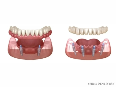 Implant Supported Dentures in Tiruppur - Shine Dentistry