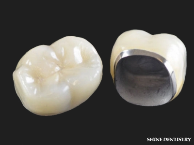 Metal-Ceramic Dental Crowns in Tiruppur - Shine Dentistry