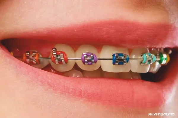 Metal orthodontic braces by expert dentist in Tiruppur