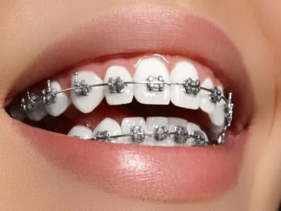 Orthodontic braces at Shine Dentistry dental clinic Tiruppur
