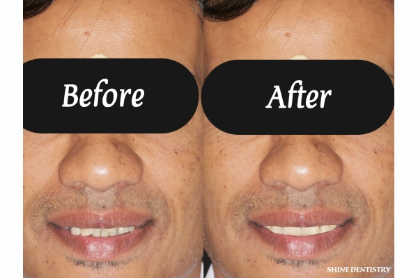Personalized Smile Correction in Tiruppur - Before and After by Shine Dentistry