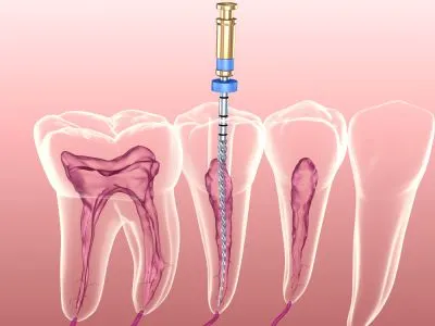 Root canal treatment at Shine Dentistry dental clinic Tiruppur