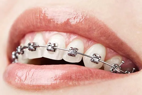 Self-ligating orthodontic braces in Tiruppur (no rubber band)