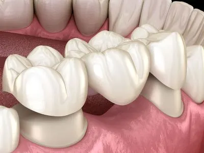 Teeth capping at Shine Dentistry dental clinic Tiruppur