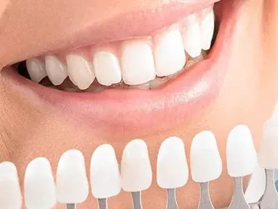 Teeth whitening at Shine Dentistry dental services Tiruppur