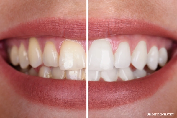 Teeth Whitening in Tiruppur - Shine Dentistry Cosmetic Dental Services
