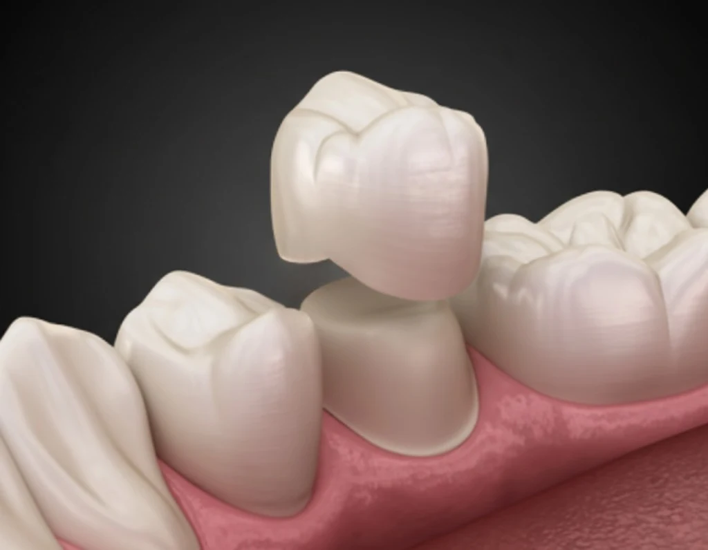 Expert tooth restoration and root canal treatment in Tiruppur