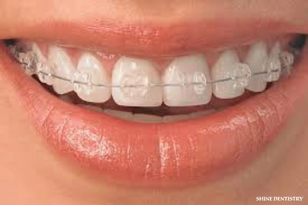 Transparent dental braces in Tiruppur