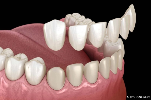 Veneer Treatments in Tiruppur for Smile Enhancement - Shine Dentistry