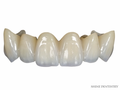 Zirconia Crowns in Tiruppur - Shine Dentistry