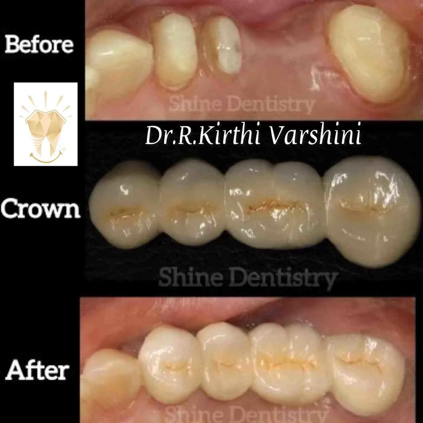 Back tooth crown restoration results