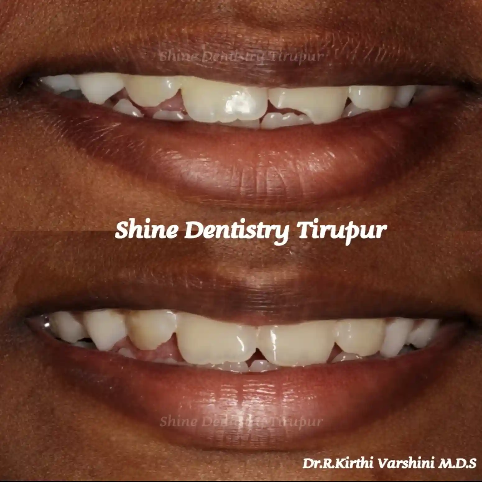 Chipped or broken tooth repaired with dental crown