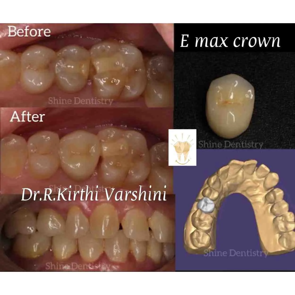 E-max ceramic crown before and after restoration