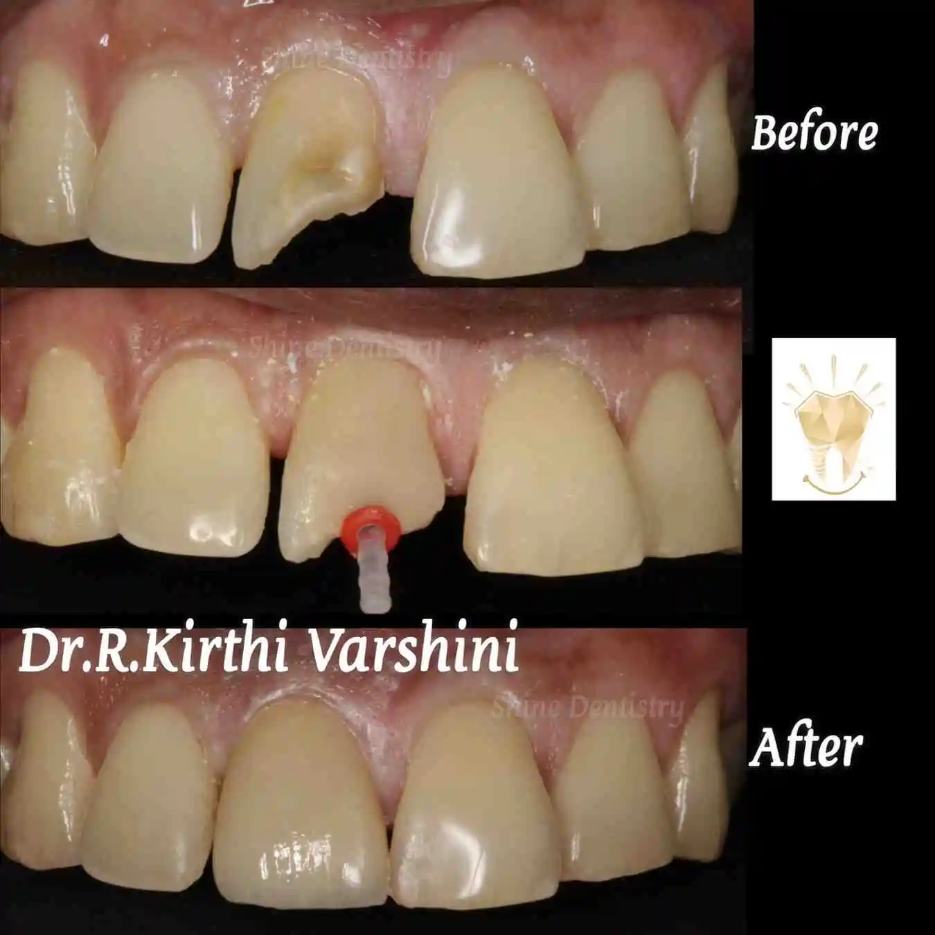 Fractured tooth repaired using crown and bonding