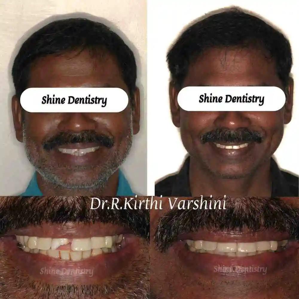 Full smile makeover with advanced cosmetic dentistry