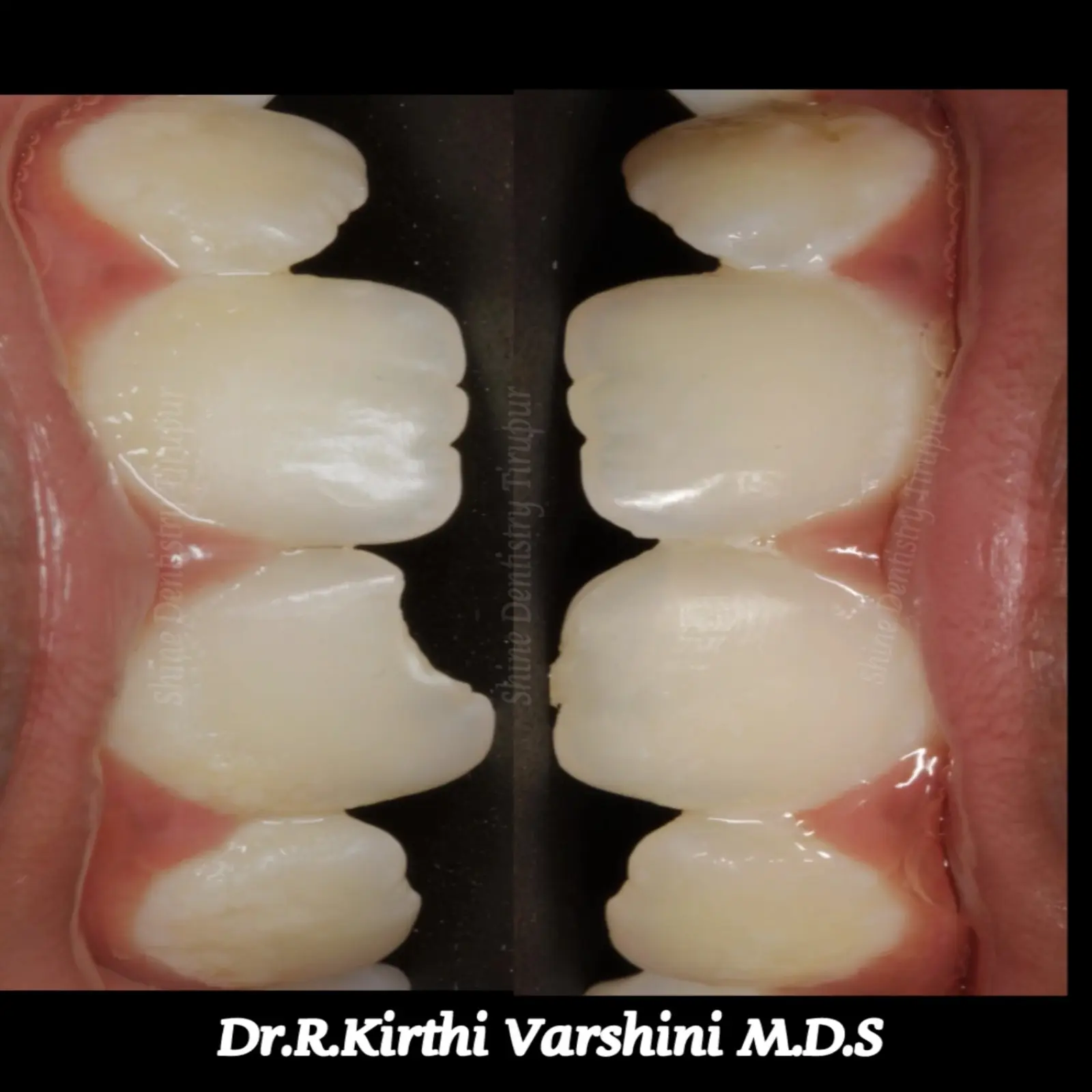 Broken tooth repair for kids before and after