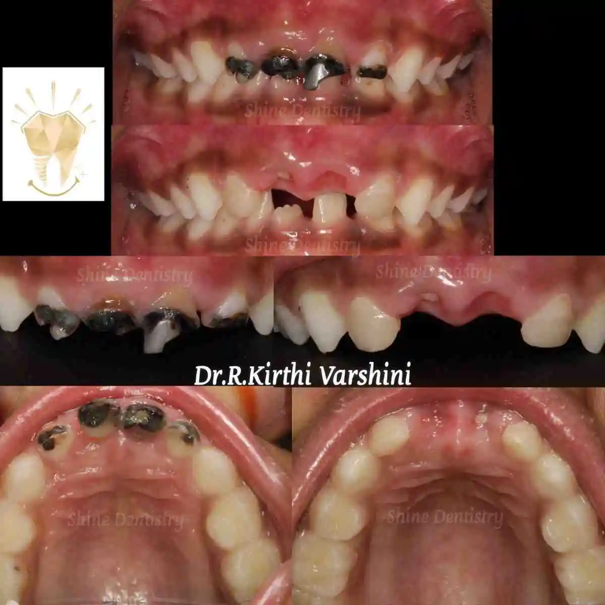 Kids cavity filling before and after results