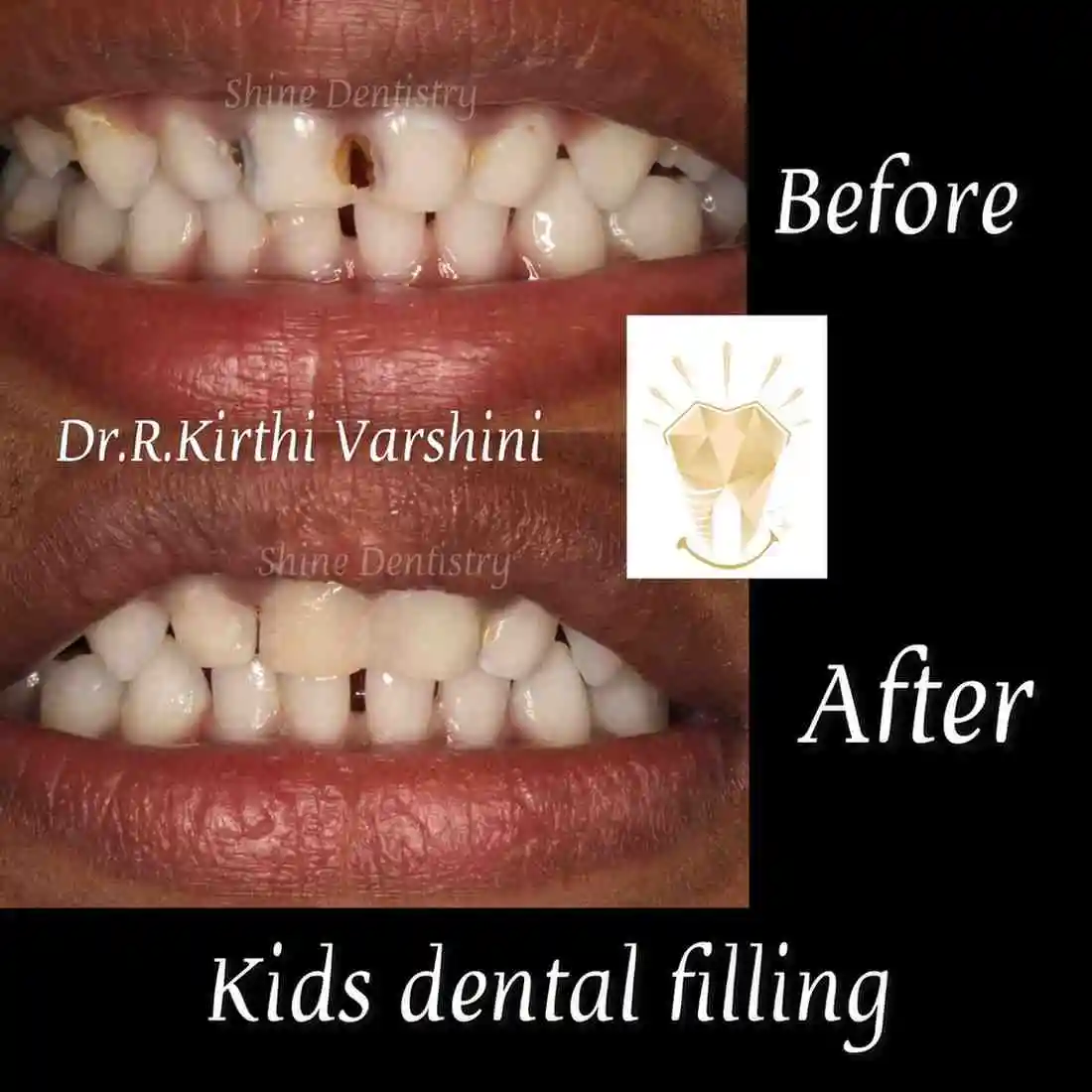 Pediatric dental filling to restore decayed tooth