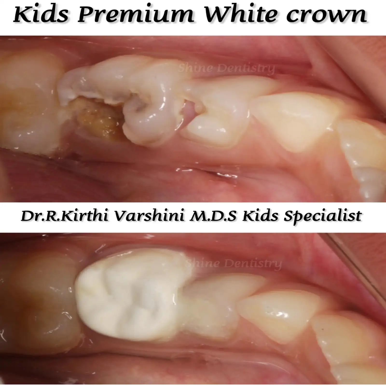 Premium white dental crown for kids