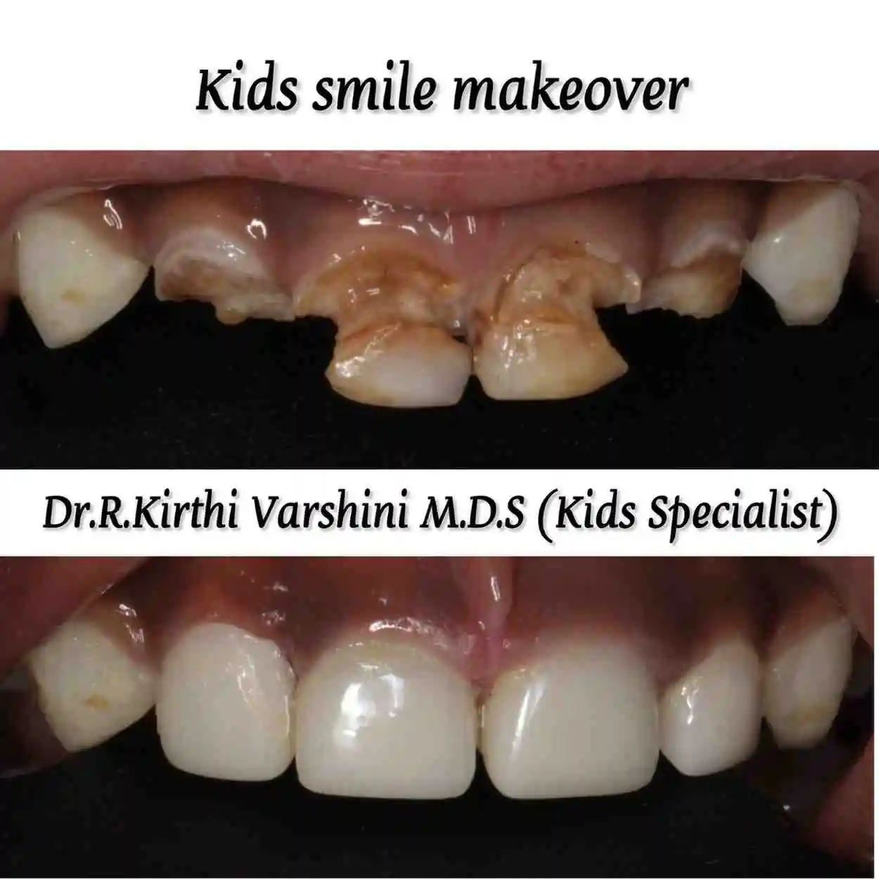 Smile makeover for kids showing improved aesthetics