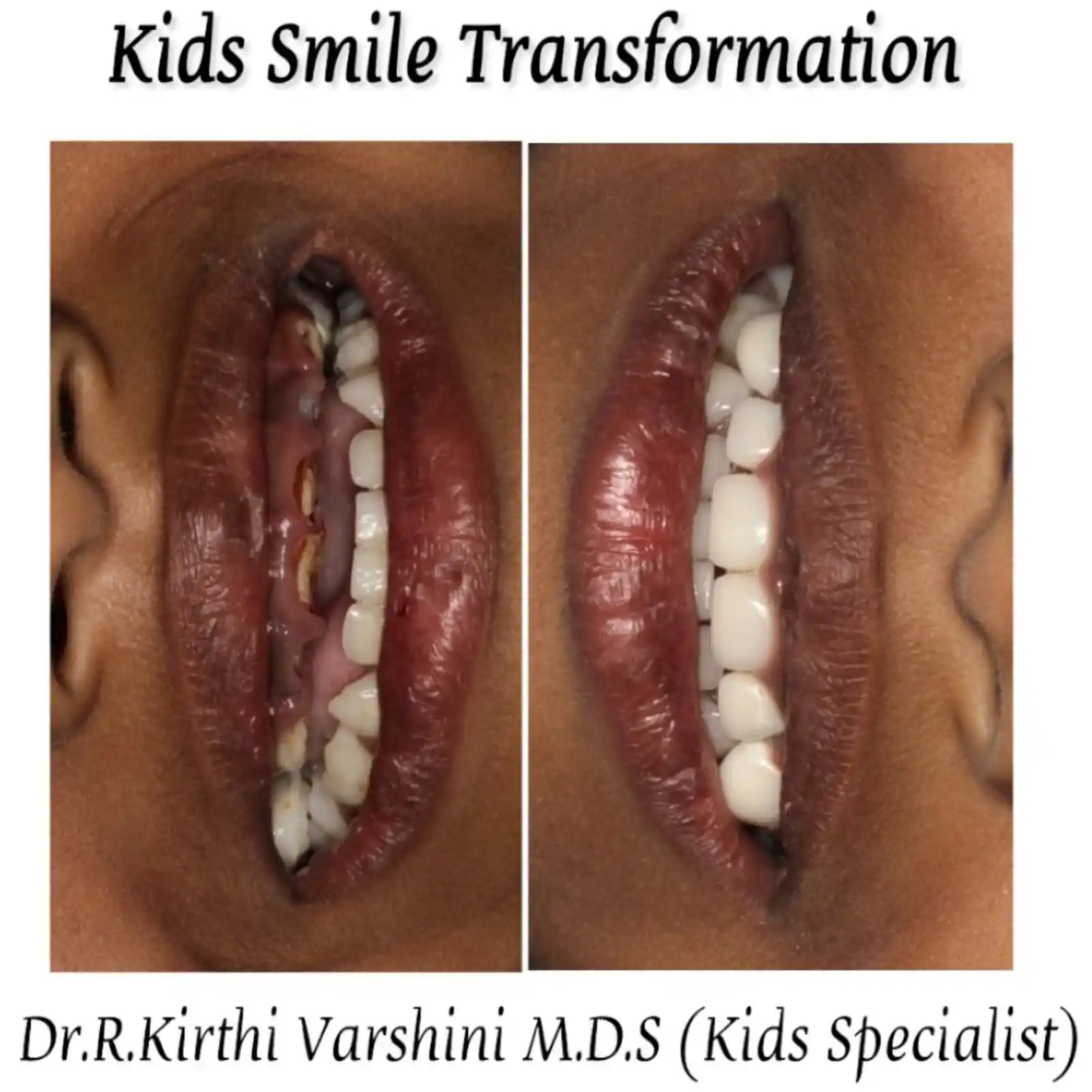 Kids smile transformation with gentle dental care
