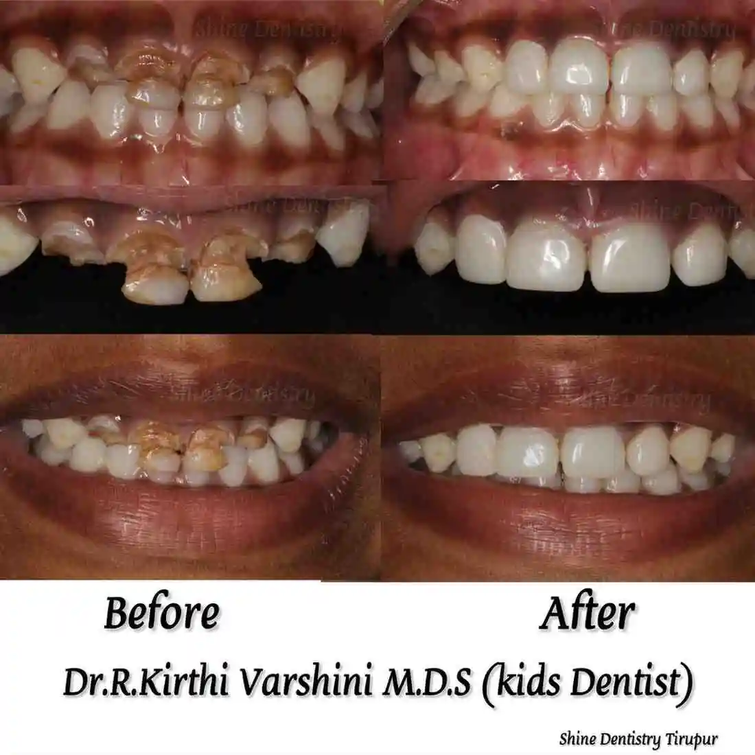 Kids teeth cleaning before and after results