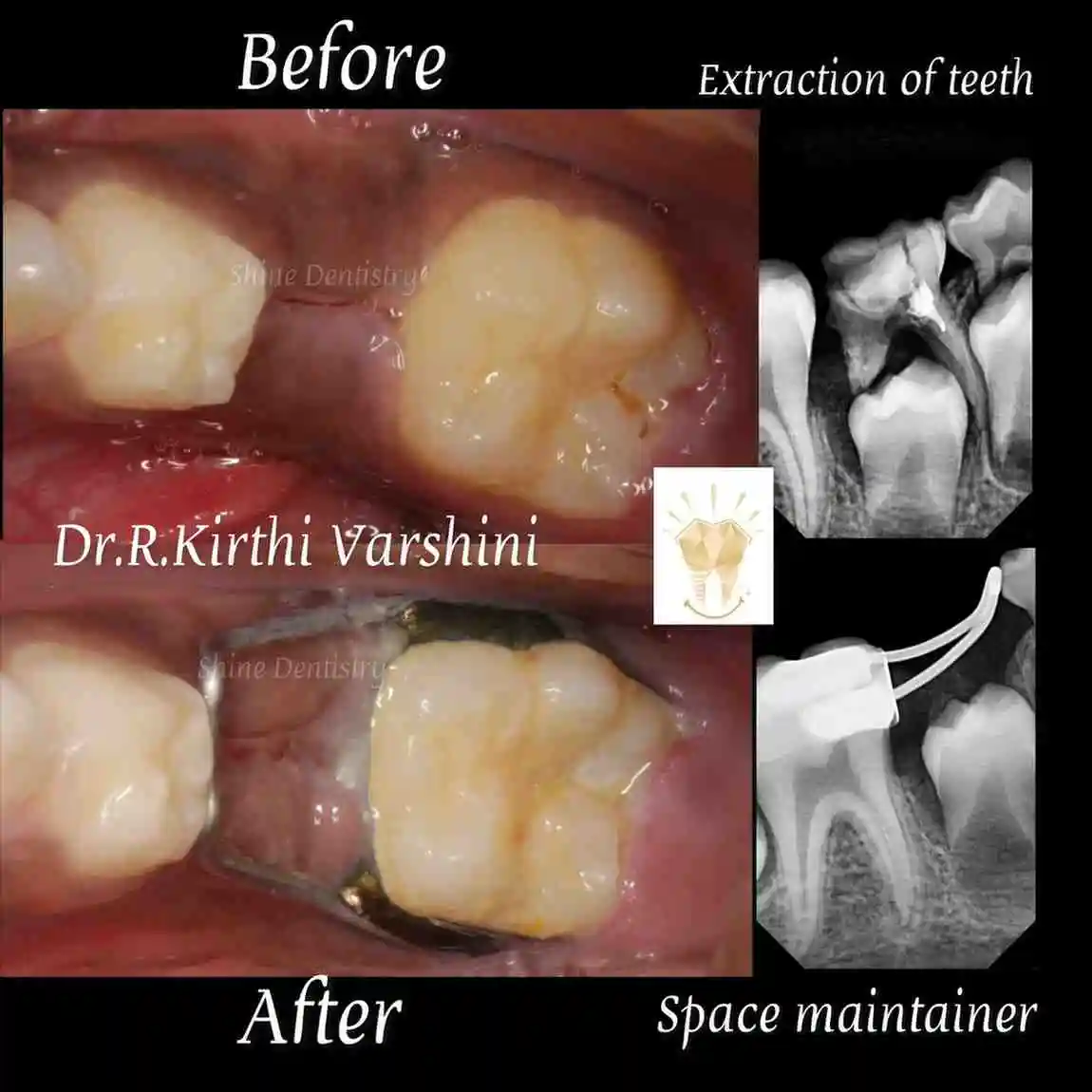 Space maintainer treatment for kids teeth alignment