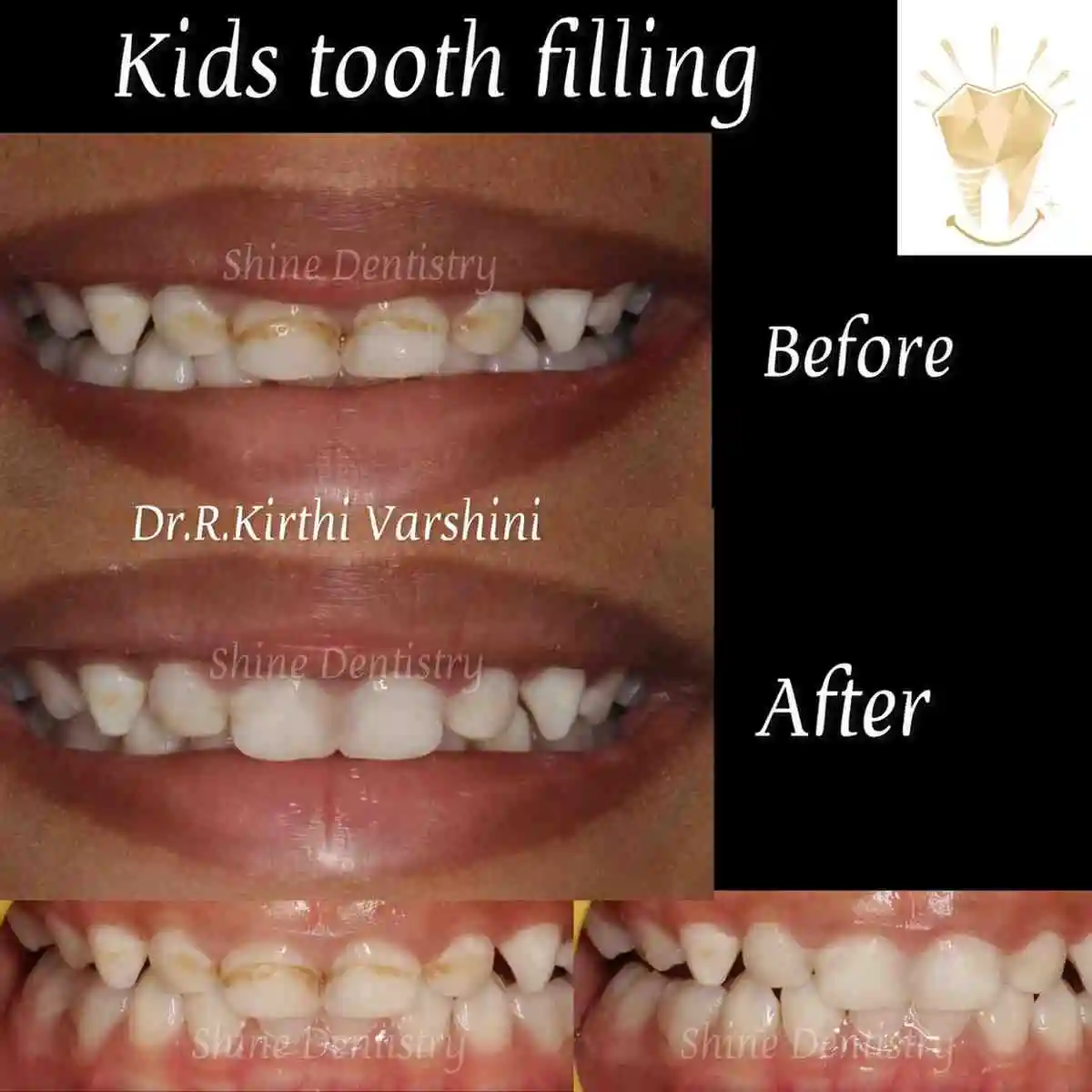 Kids tooth filling before and after cavity restoration in Tiruppur