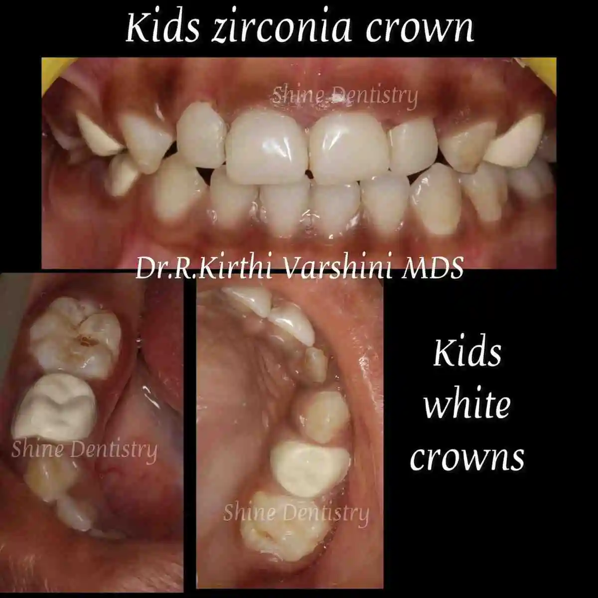 Zirconia crown treatment for kids front teeth in Tiruppur