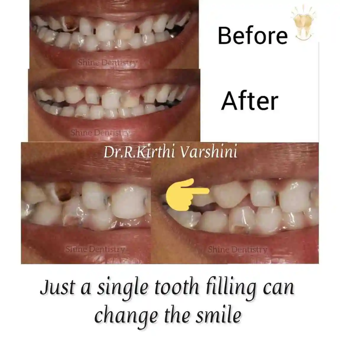 Single tooth filling before and after results