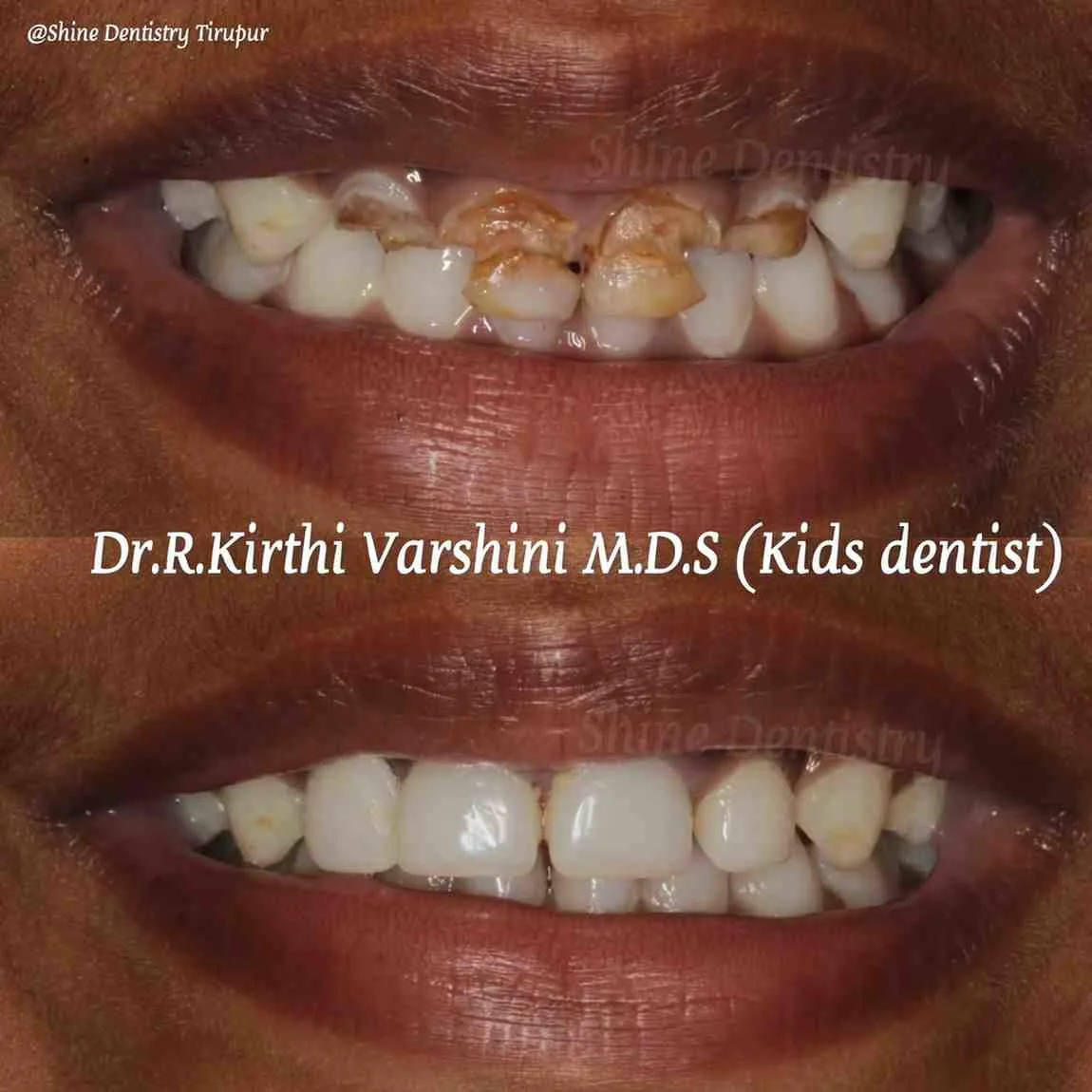 Professional teeth cleaning and polishing results in Tiruppur