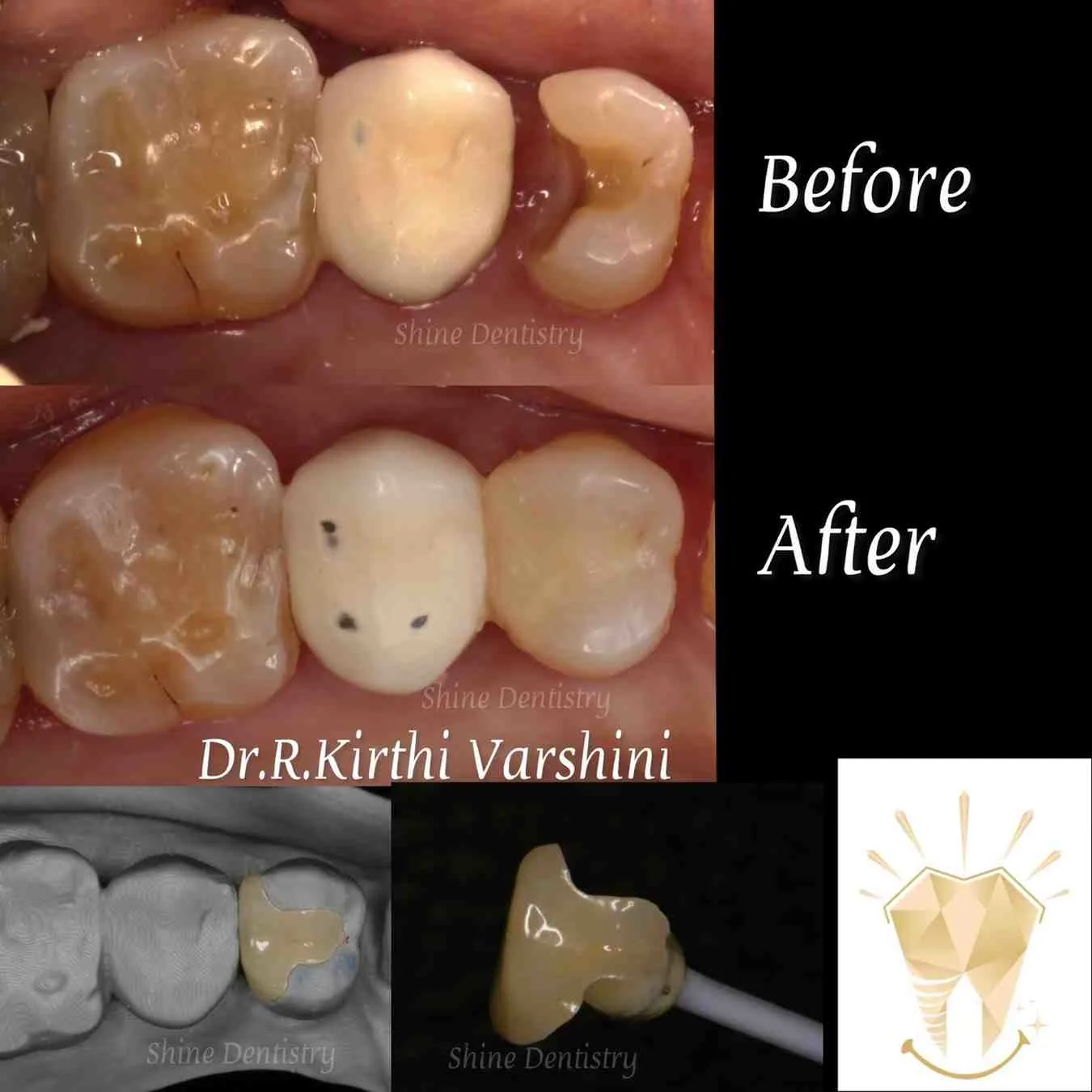Dental crown placement for tooth restoration