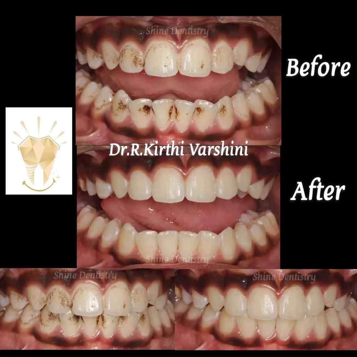 Teeth whitening before and after results for adults