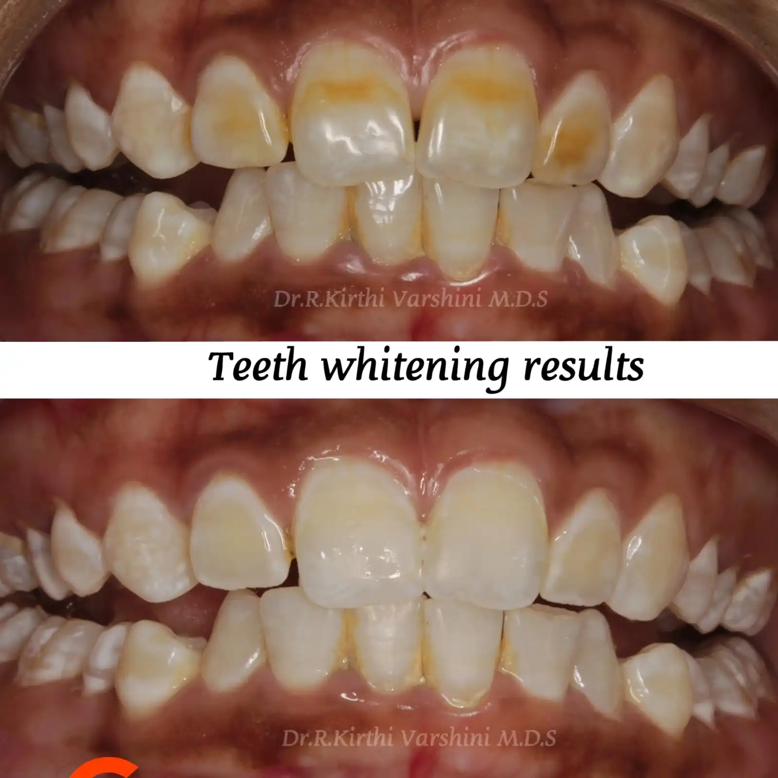 Professional teeth whitening results with brighter smile in Tiruppur