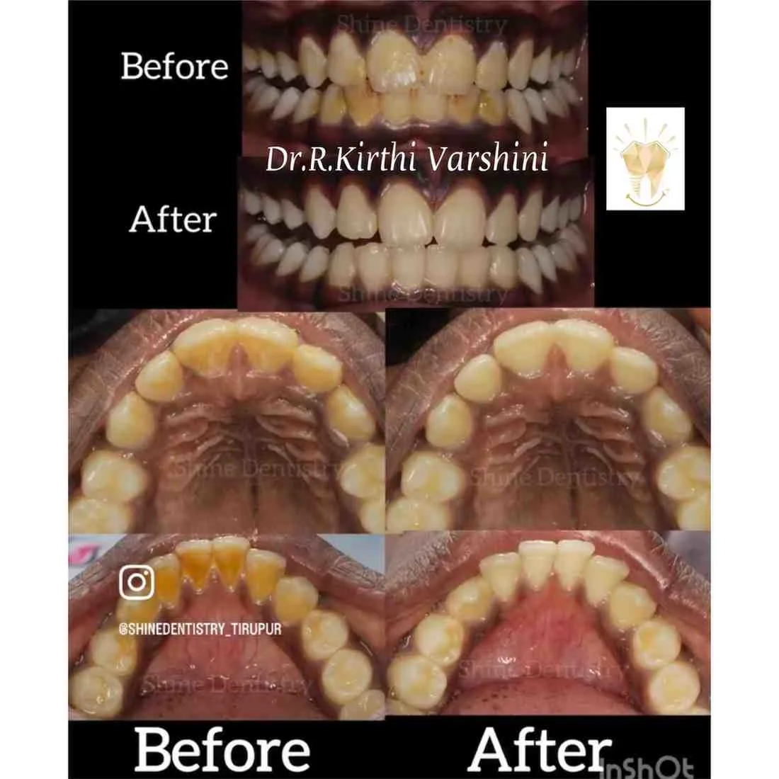 Teeth whitening session showing natural white teeth