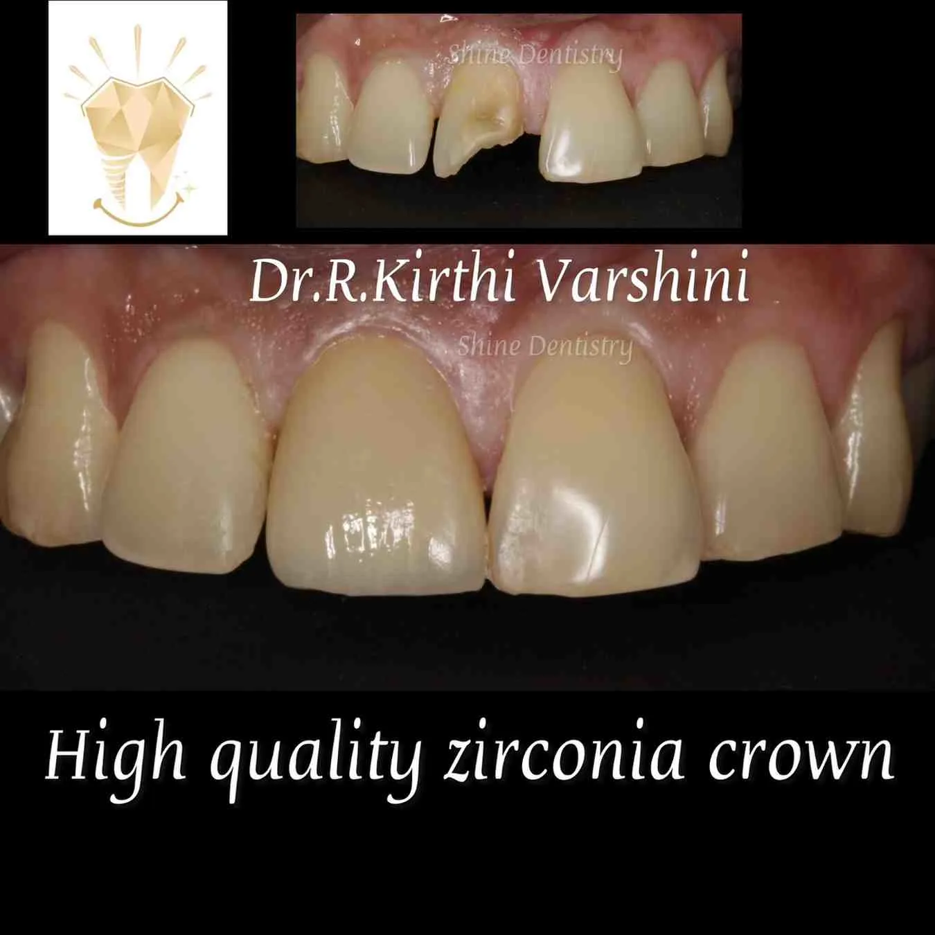 Zirconia crown before and after smile improvement in Tiruppur