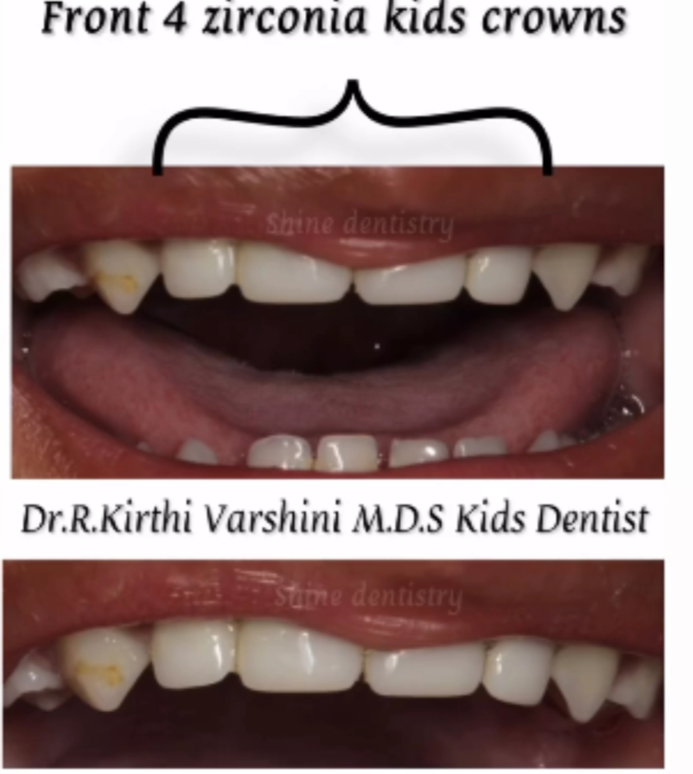 Kids zirconia crowns before and after results